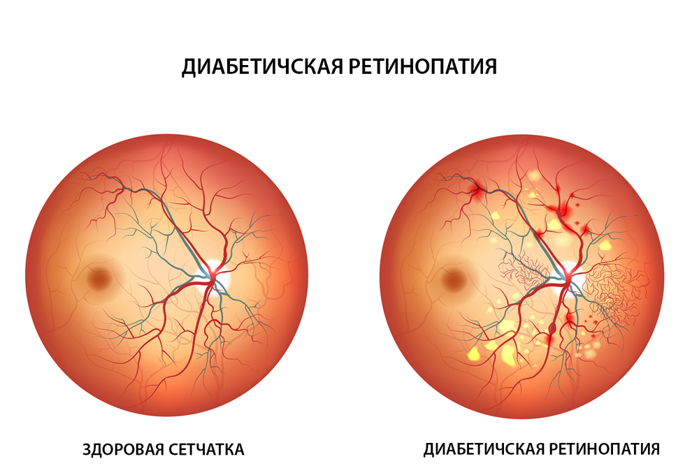 diabeticeskaia-retinopatiia-glaz