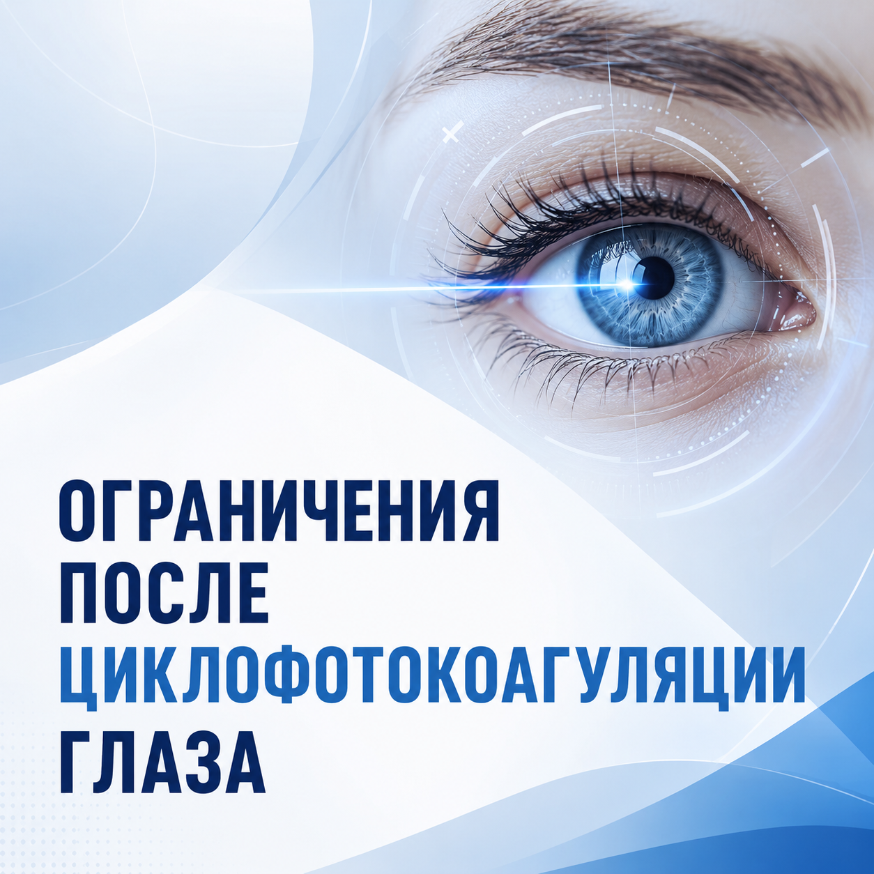 циклофотокоагуляция ульяновск