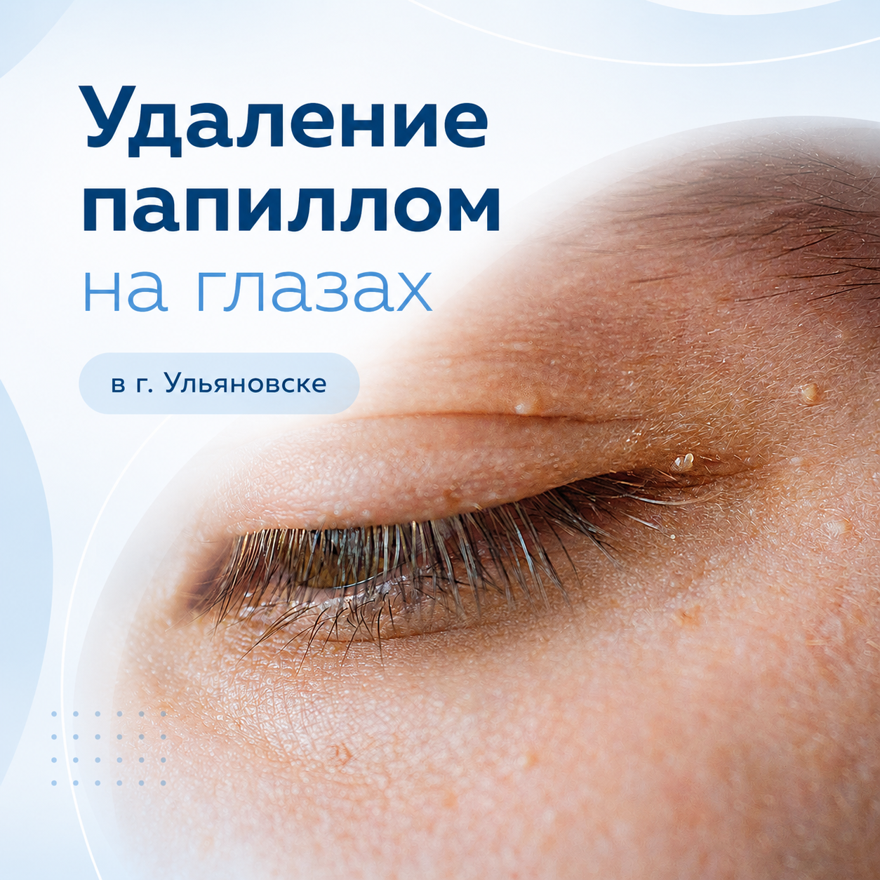 удаление папиллом в ульяновске
